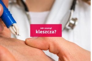 jak usunąć kleszcza
